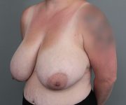 before breast reduction left angle view of female patient 6097