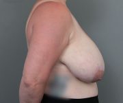 before breast reduction right side view of female patient 6097