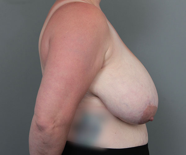 before breast reduction right side view of female patient 6097