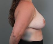 after breast reduction right side view of female patient 6097