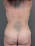 after liposuction front view of female patient 6104