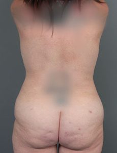 after liposuction front view of female patient 6104