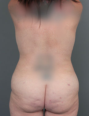after liposuction front view of female patient 6104
