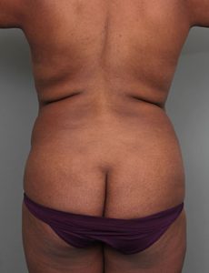 before liposuction front view of female patient 6109