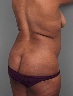 before liposuction right angle view of female patient 6109