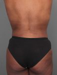 after liposuction front view of female patient 6109