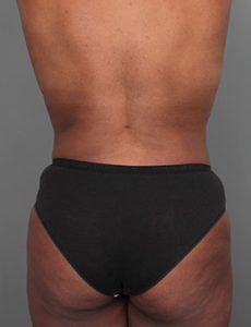 after liposuction front view of female patient 6109