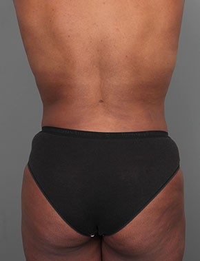 after liposuction front view of female patient 6109
