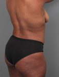 after liposuction right angle view of female patient 6109