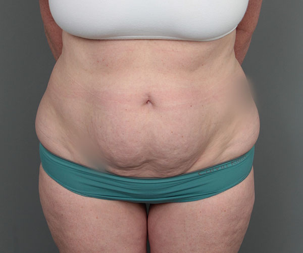 before tummy tuck front view of female patient 6069