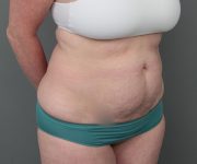 before tummy tuck right angle view of female patient 6069