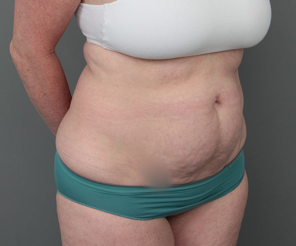 before tummy tuck right angle view of female patient 6069