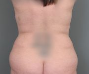 before tummy tuck rear view of female patient 6069