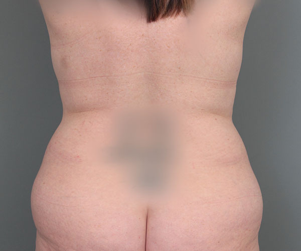before tummy tuck rear view of female patient 6069