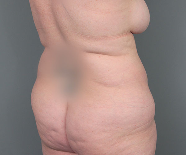 before tummy tuck rear right angle view of female patient 6069
