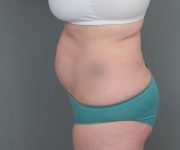 before tummy tuck left side view of female patient 6069