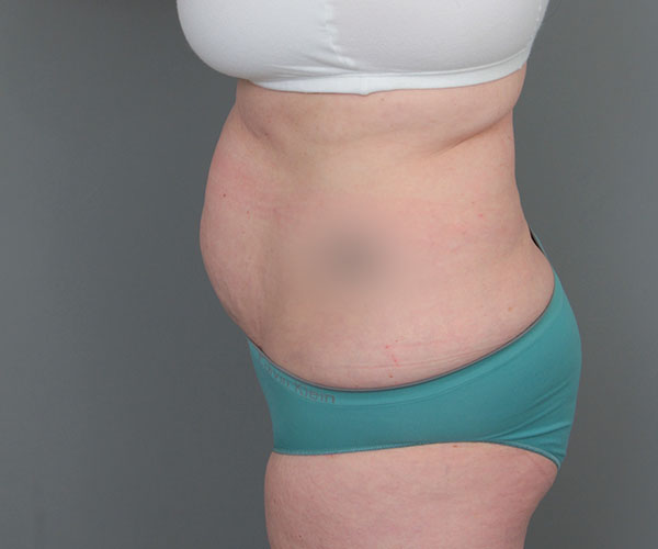 before tummy tuck left side view of female patient 6069