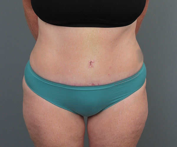after tummy tuck front view of female patient 6069
