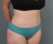 after tummy tuck right angle view of female patient 6069