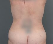 after tummy tuck rear view of female patient 6069