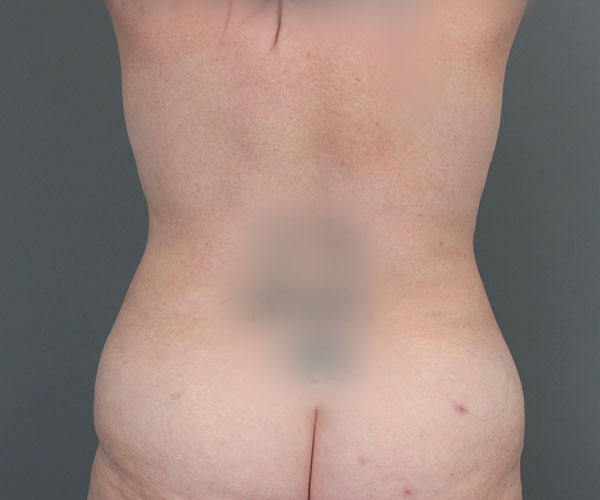 after tummy tuck rear view of female patient 6069