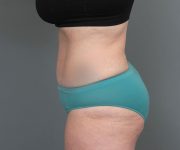 after tummy tuck left side view of female patient 6069