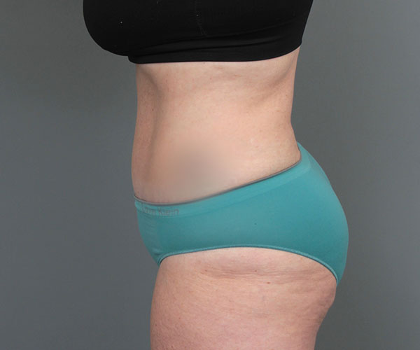 after tummy tuck left side view of female patient 6069