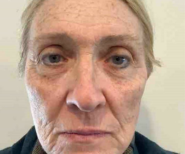 before BBL MOXI front view of female patient 6187