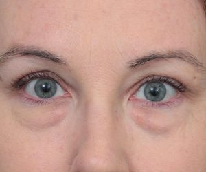 before eyelid lift front view of female patient 6174
