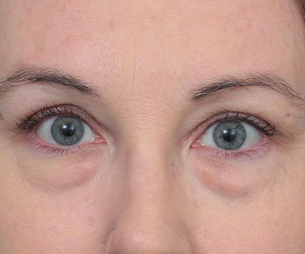 before eyelid lift front view of female patient 6174