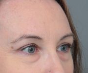 before eyelid lift right angle view of female patient 6174