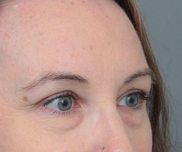 before eyelid lift right angle view of female patient 6174
