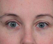 after eyelid lift front view of female patient 6174