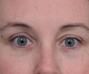 after eyelid lift front view of female patient 6174