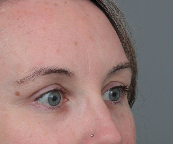 after eyelid lift right angle view of female patient 6174
