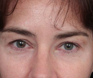 before eyelid lift front view of female patient 6179