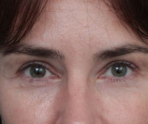 after eyelid lift front view of female patient 6179
