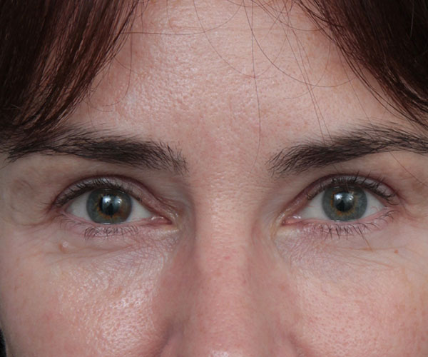 after eyelid lift front view of female patient 6179
