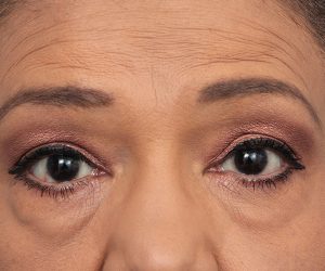 before eyelid lift front view of female patient 6182