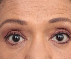 after eyelid lift front view of female patient 6182