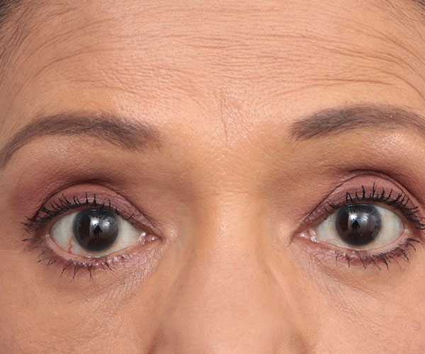 after eyelid lift front view of female patient 6182