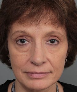 after rhinoplasty front view of female patient 6160