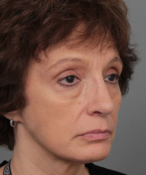 after rhinoplasty right angle view of female patient 6160