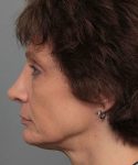 after rhinoplasty left side view of female patient 6160
