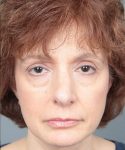 before rhinoplasty front view of female patient 6160