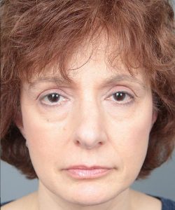 before rhinoplasty front view of female patient 6160