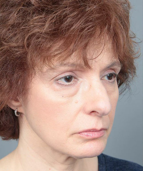 before rhinoplasty right angle view of female patient 6160