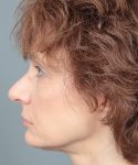 before rhinoplasty left side view of female patient 6160