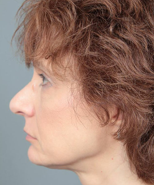 before rhinoplasty left side view of female patient 6160
