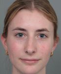 after rhinoplasty front view of female patient 6360